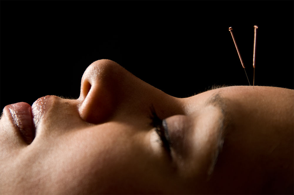 cosmetic acupuncture