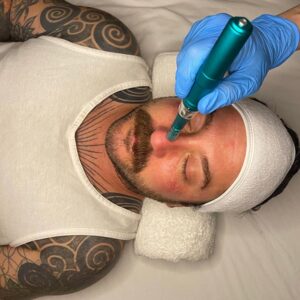 microneedling